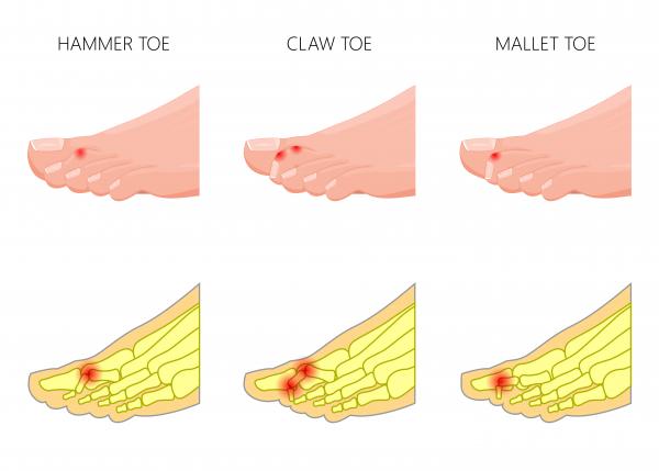 hammertoes