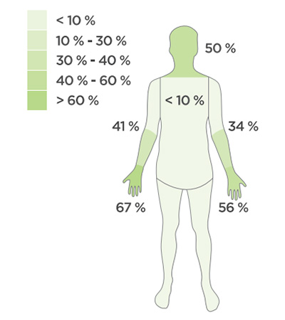 Illustration de la répartition des risques thermiques sur le corps - arc électrique - Vandeputte Safety Experts