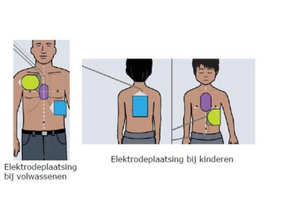 ZOLL AED 3 CPR UNI-PADZ ELEKTRODENSET